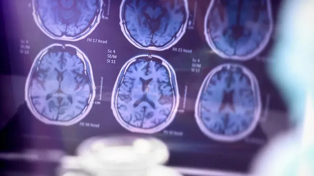 Alzheimer aşısının ilk sonuçları açıklandı